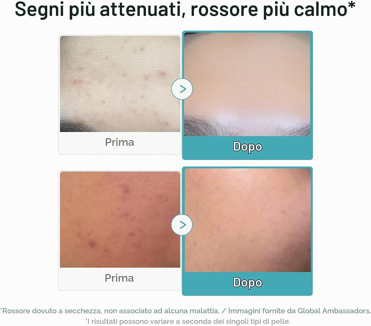 Medicube Azelaic Acid 16% Soothing Serum — Siero Purificante Anti-Imperfezioni